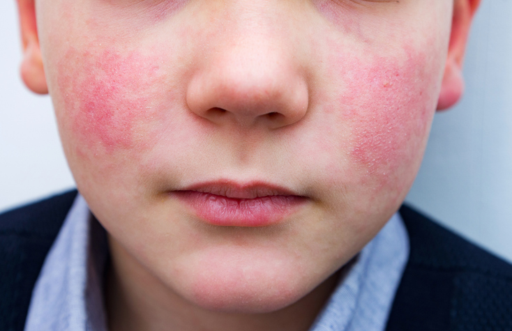 Photo shows a child whose face is flushed/Getty Images