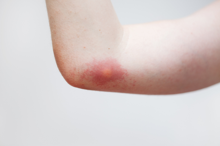 Photo shows a reaction on skin to a wasp sting/Getty Images