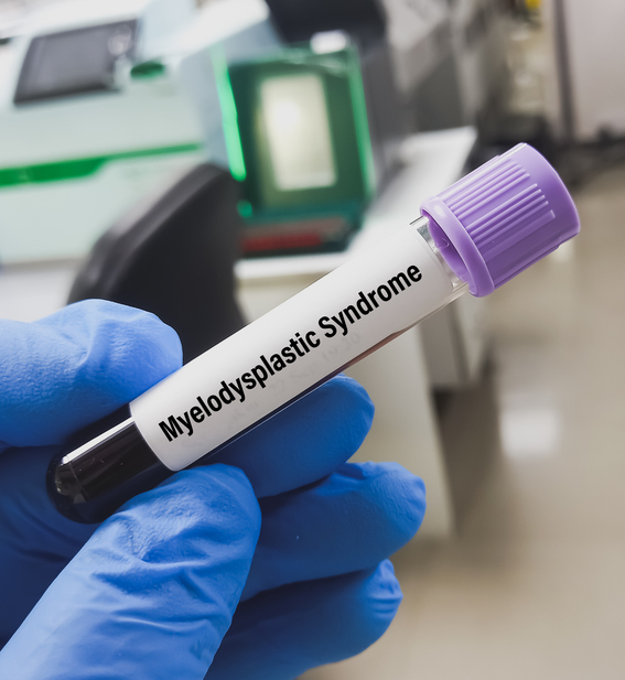 Photo shows a blood sample for Myelodysplastic syndrome test/Getty Images