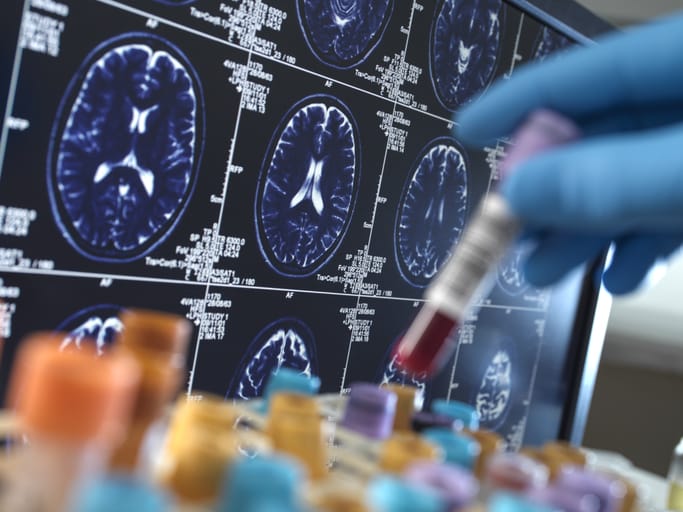 Photo shows a scientist holding a blood sample during a clinical trial with a MRI on screen/Getty Images