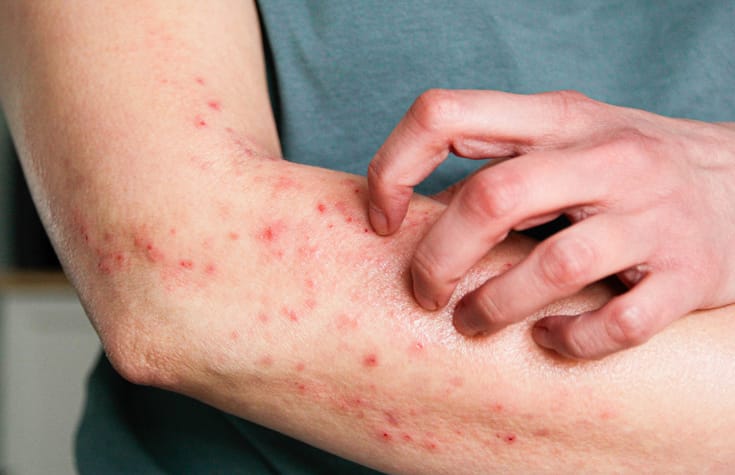 Photo shows skin rash