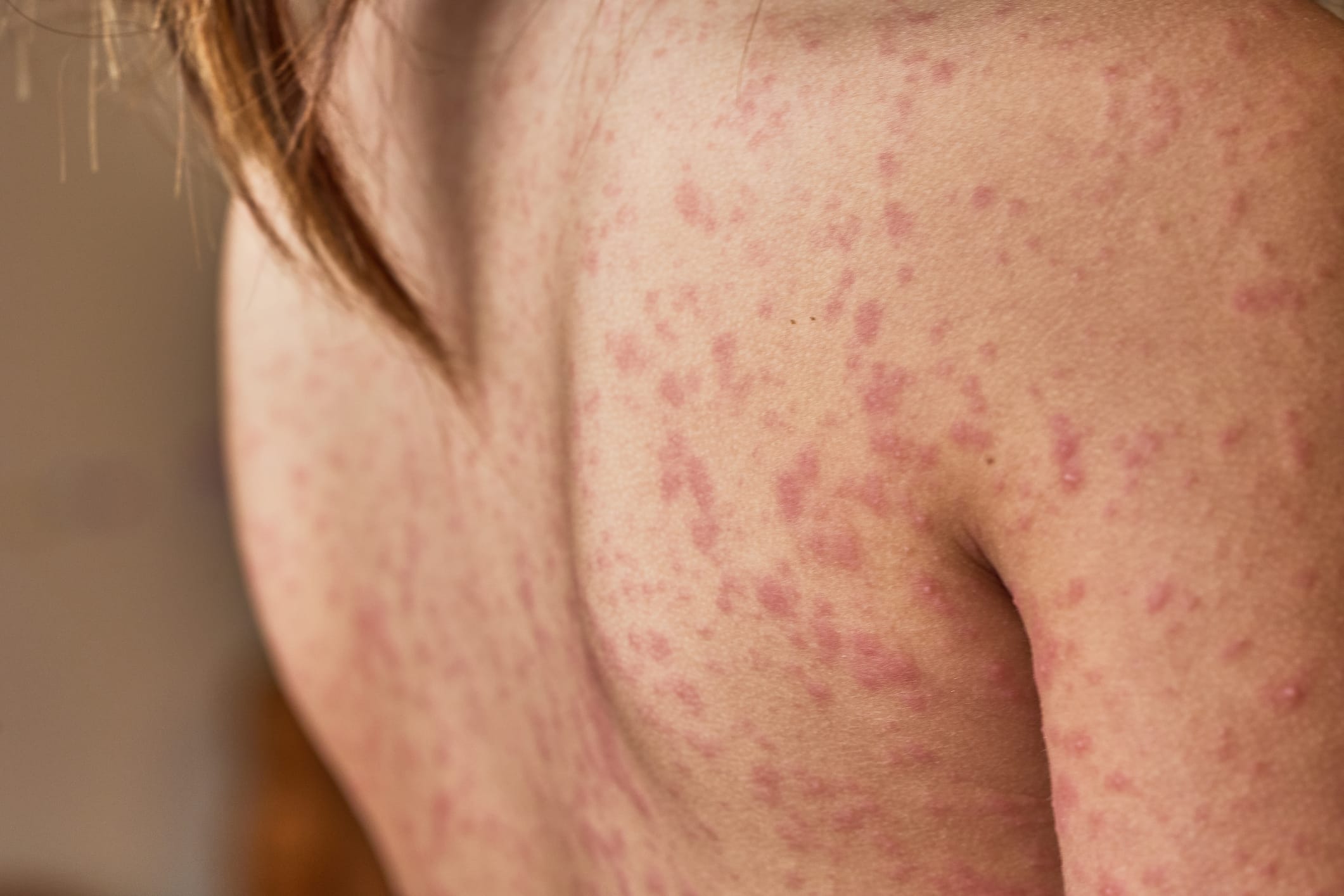 Rash on a patient's back