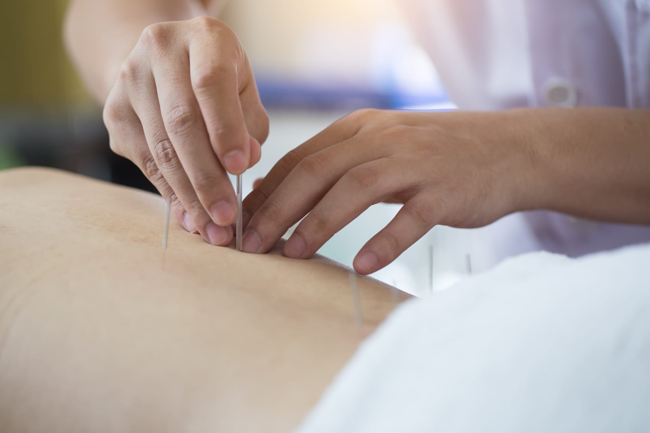 Acupuncture may help regulate mast cells