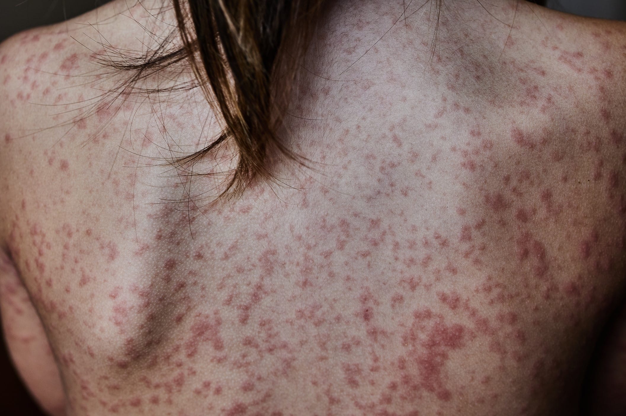 Back of a patient with skin lesions
