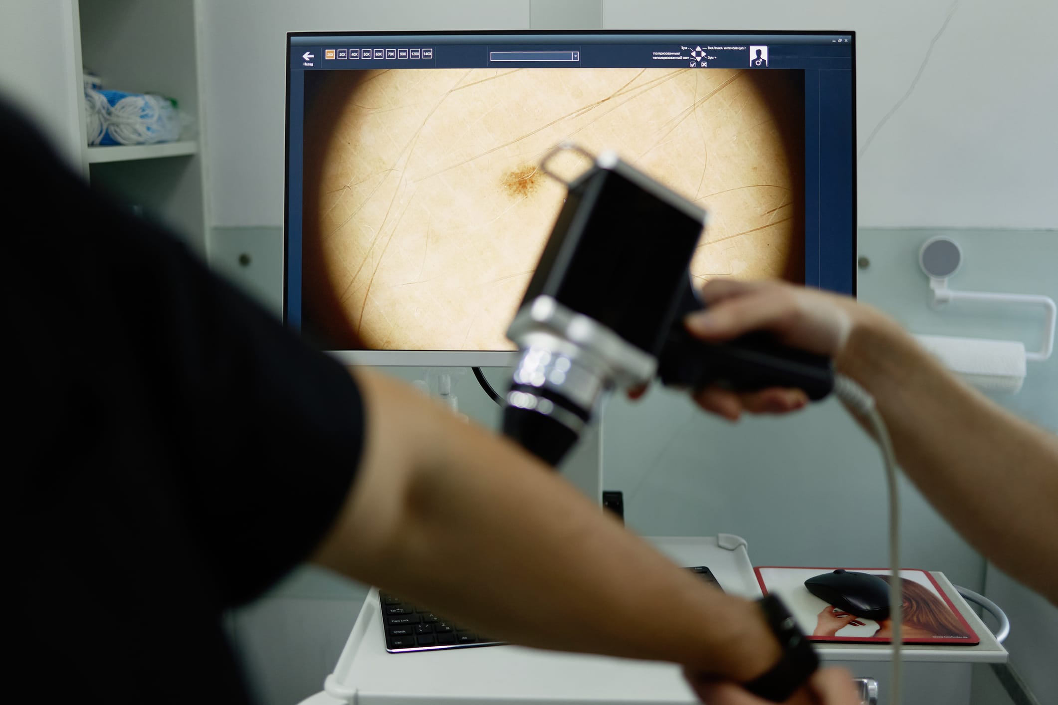 Doctor checking a patient for skin cancer