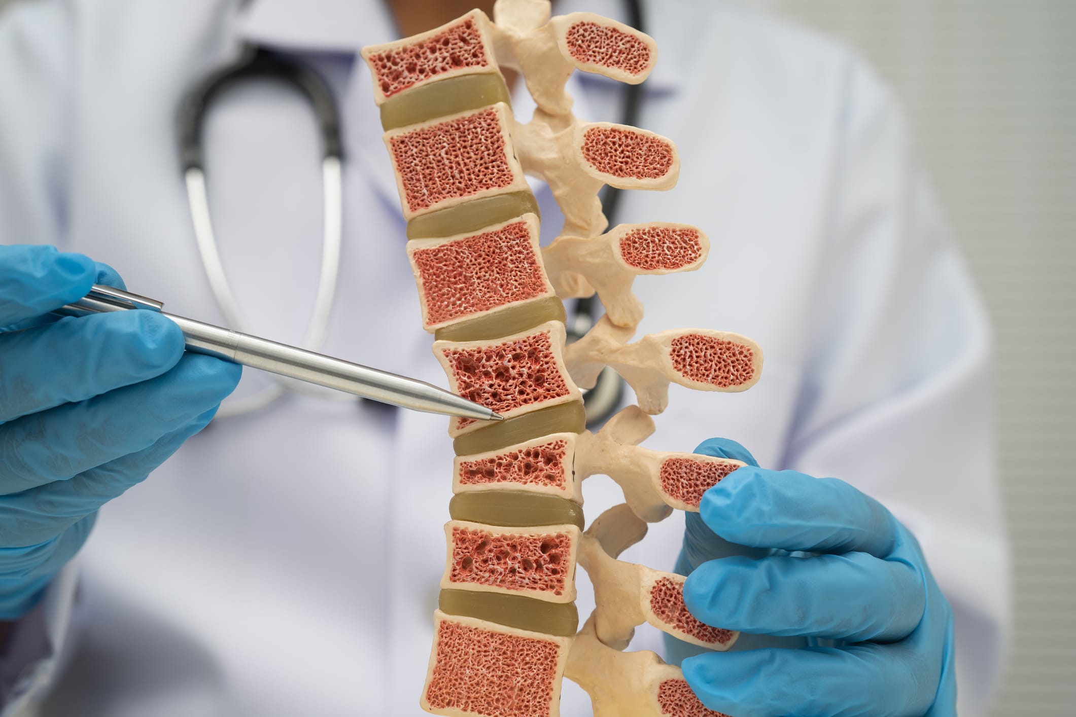 Doctor holding osteoporosis in back bone model.