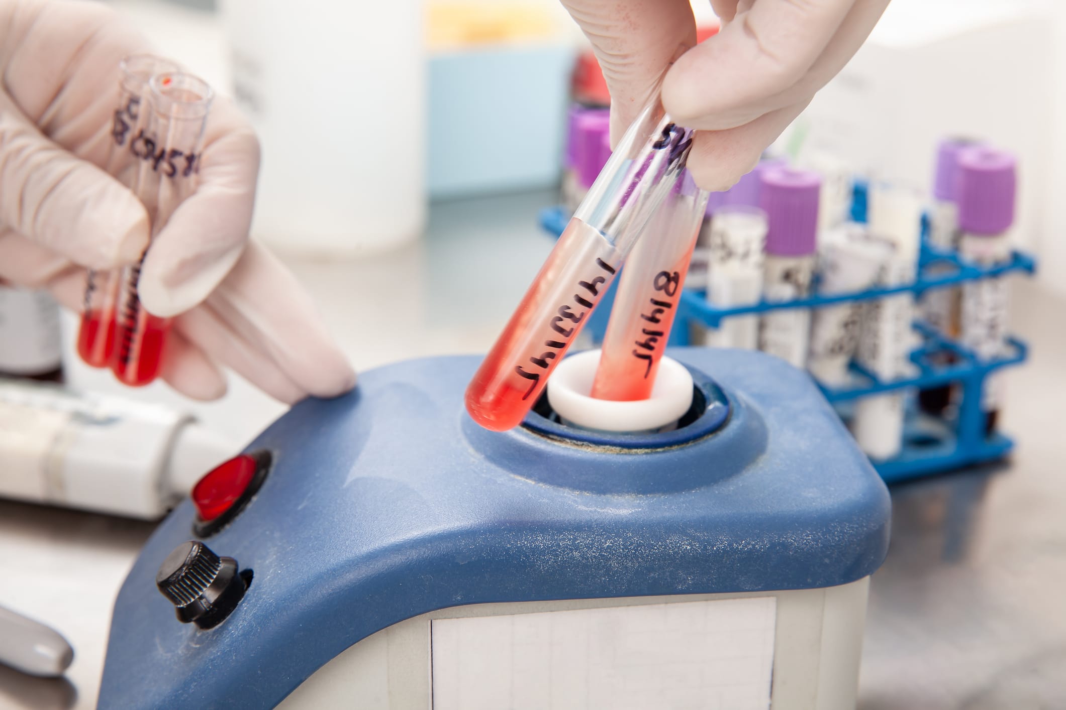 Scientist using a vortex to mix contents in a test tube. Scientist preparing bone marrow samples for flow cytometric analysis in the laboratory.