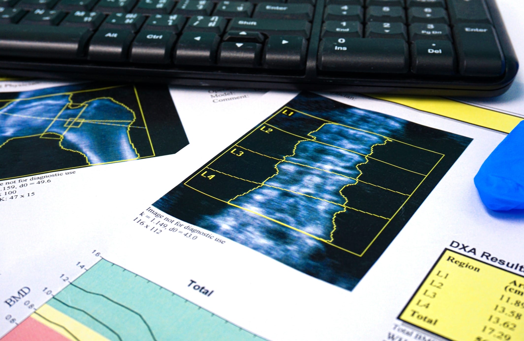 Close up Bone Densitometry Result on the table